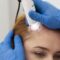 microneedling scalp